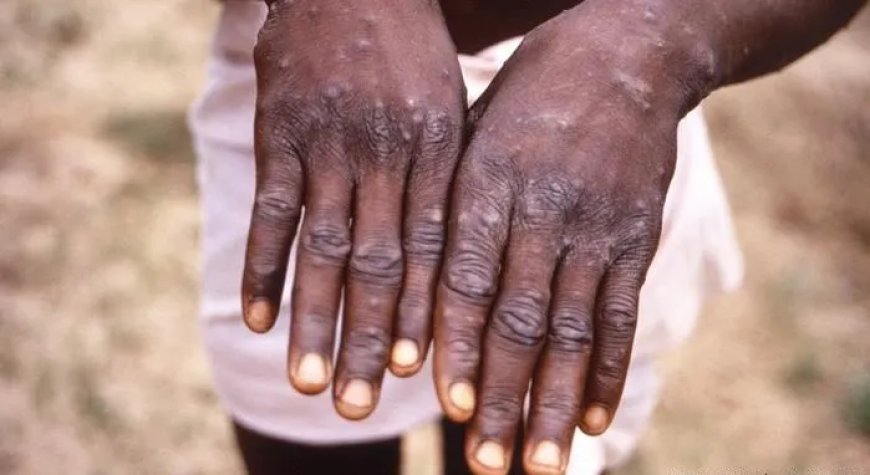 Le ministère de la Santé apporte des précisions sur le monkeypox en Algérie