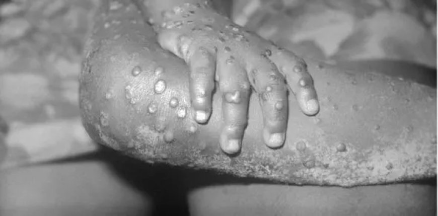 Maroc: 3 cas suspects d’infection avec la variole du singe détectés… le virus monkeypox est arrivé au Maroc