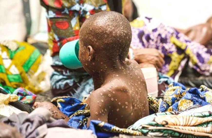 Mpox en Afrique : Les enfants particulièrement menacés par la nouvelle variante