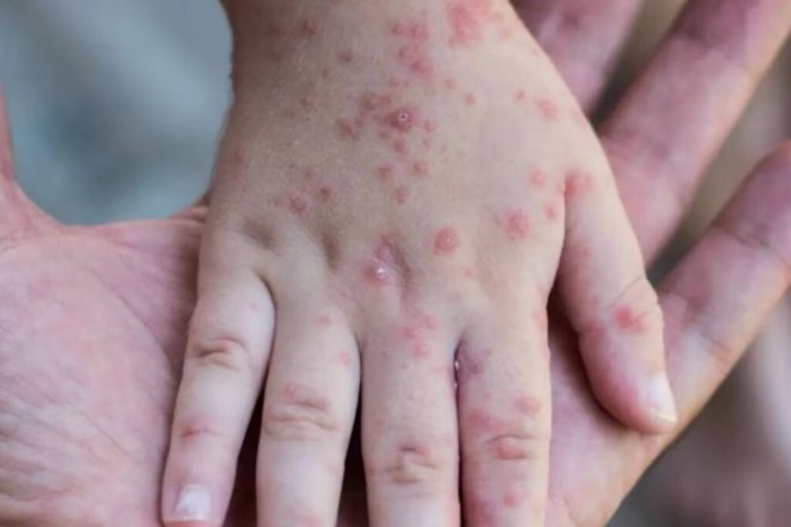 Mpox : l’Algérie renforce sa défense face à la menace de la variole du singe